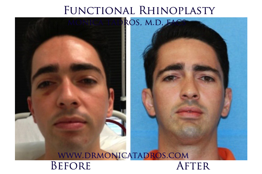 Functional-Rhinoplasty-NJ-before-after-photo-010-2
