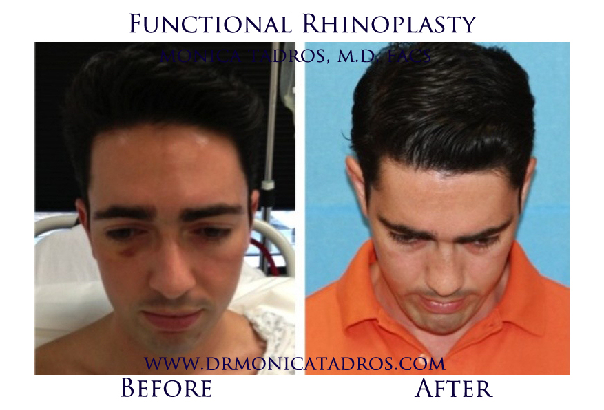 Functional-Rhinoplasty-NJ-before-after-photo-013
