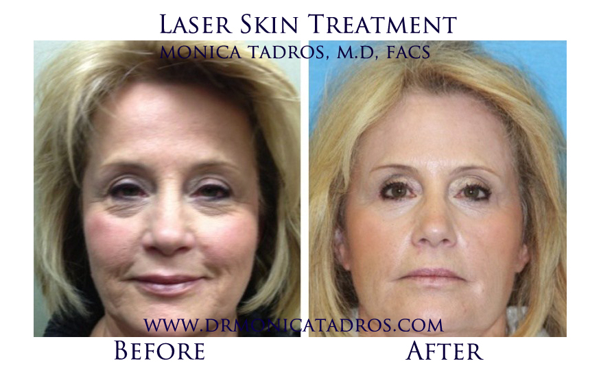 Laser-Skin-Treatment-NJ-before-after-photo-003