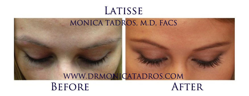 Latisse-NJ-before-after-photo-001