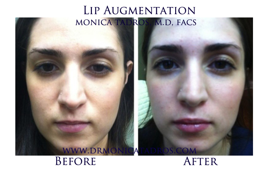 Lip-Augmentation-NJ-before-after-photo-005