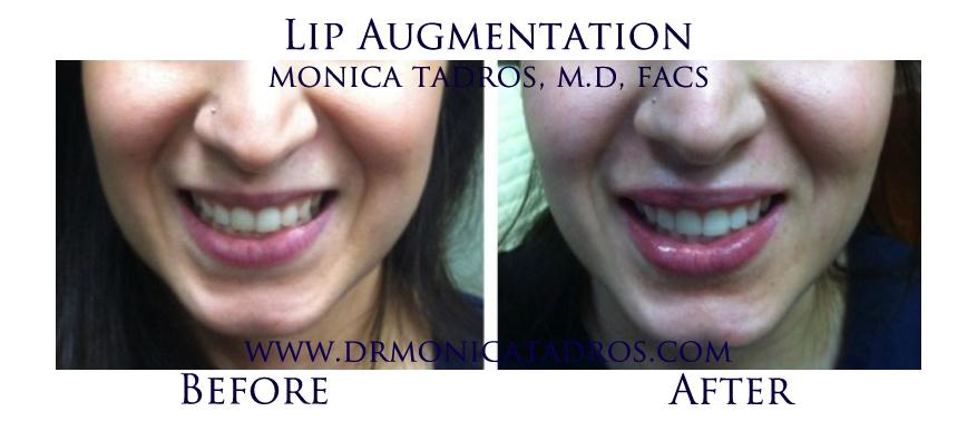 Lip-Augmentation-NJ-before-after-photo-007