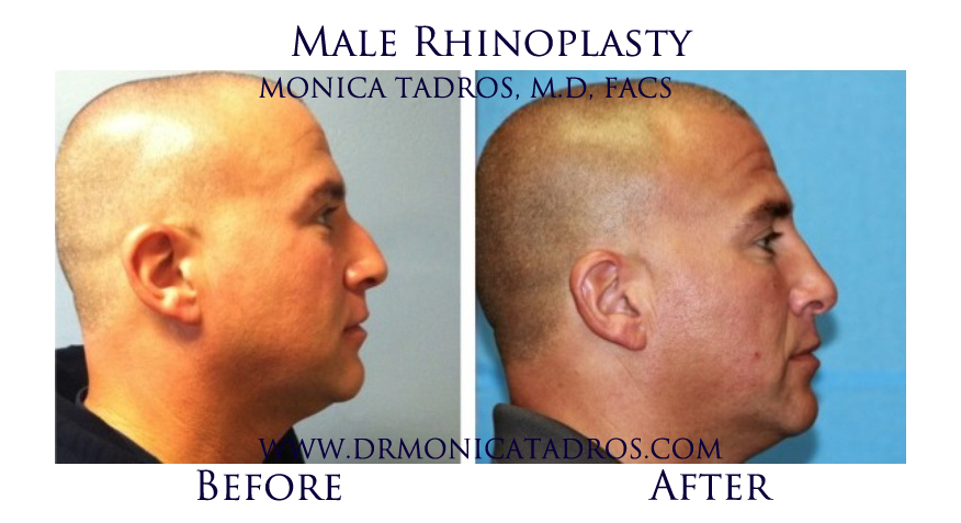 Before After Photo Male Rhinoplasty