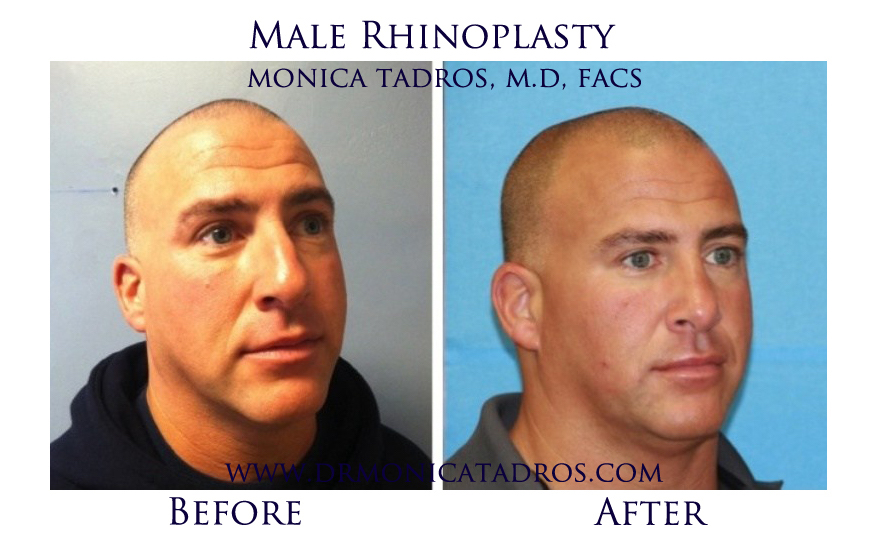 Male Rhinoplasty in NJ Before After Photo