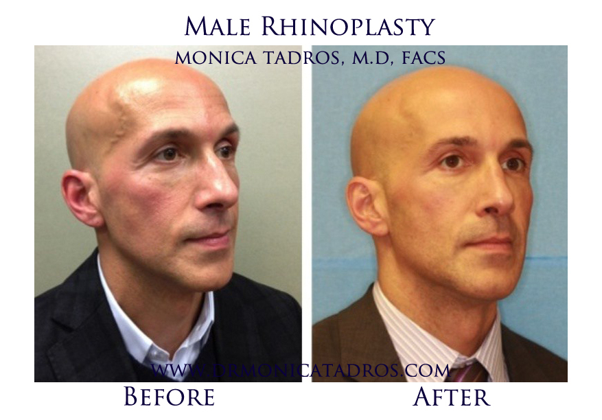 Male Rhinoplasty NJ Before After
