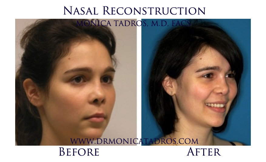 Nasal-Reconstruction-NJ-before-after-photo-001
