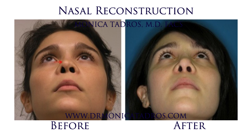 Nasal-Reconstruction-NJ-before-after-photo-003
