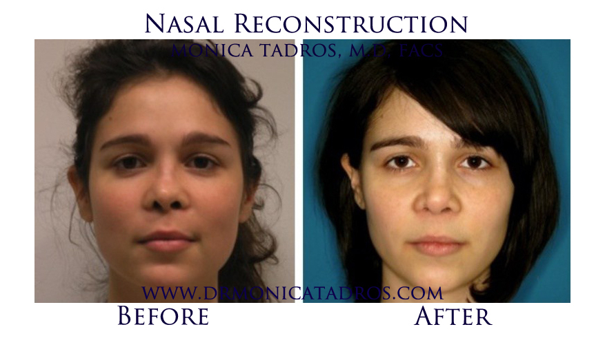 Nasal-Reconstruction-NJ-before-after-photo-004