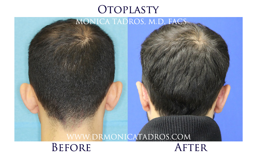 Otoplasty-NJ-before-after-photo-002