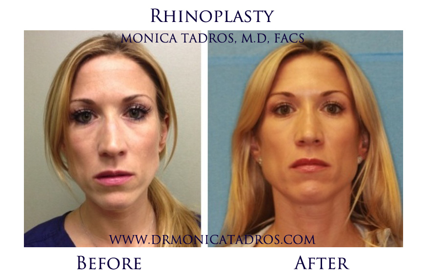 Before and After Adult Nose Reconstruction