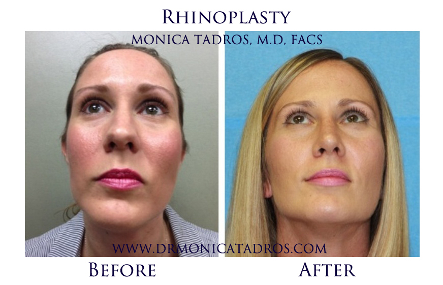 Rhinoplasty Before & After H Dr. Monica Tadros Sinus, Sleep & Facial Plastic Surgery NJ