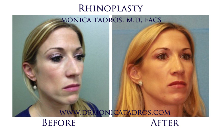 Adult Rhinoplasty Before and After