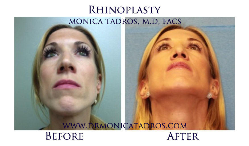 NJ Rhinoplasty Before and After