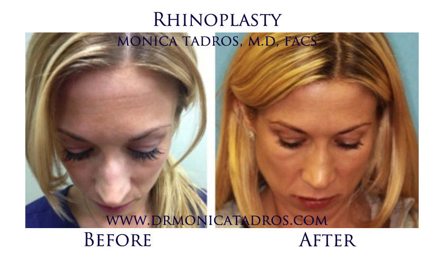 Female Rhinoplasty in NJ Before and After