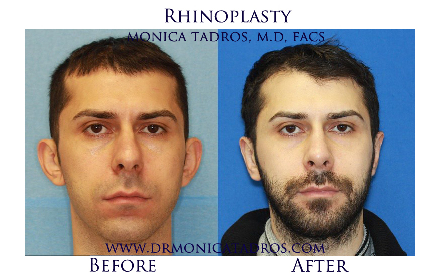 Rhinoplasty NJ Before After