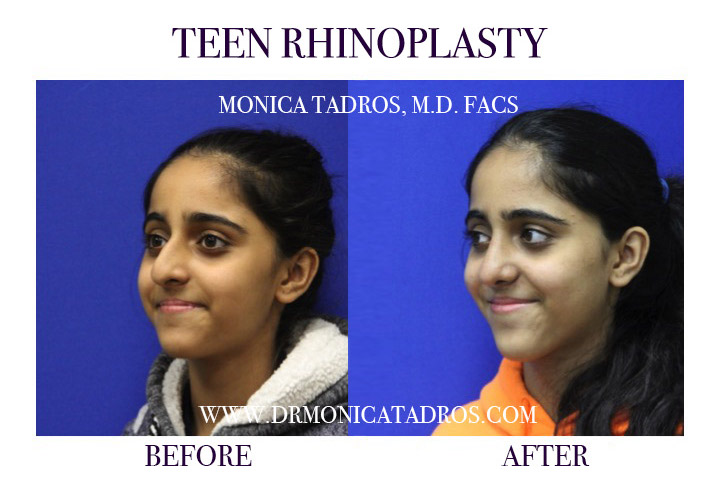 Before and After Teen Rhinoplasty