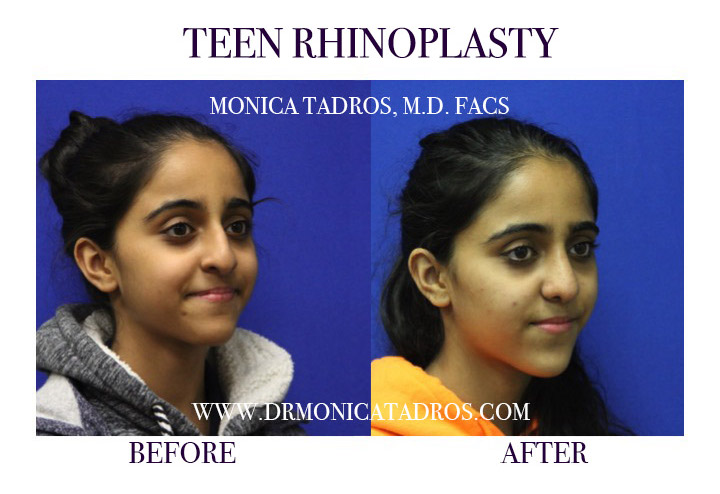 Teen Nose Job Procedure Before & After