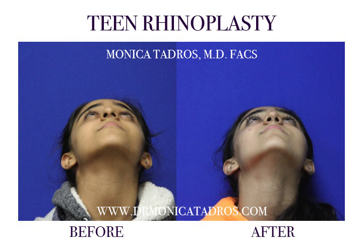 Teen Rhinoplasty in NJ & NYC Before and After