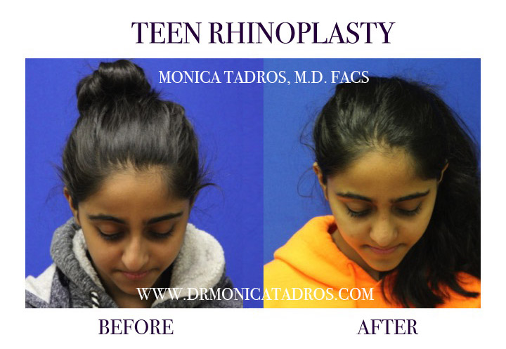 Teen Nose Reconstruction Before & After Picture