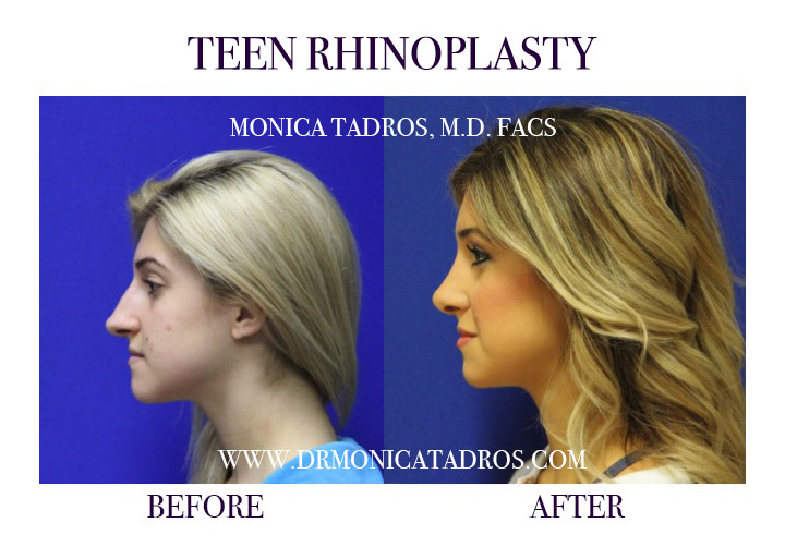 Teen Rhinoplasty Before & After