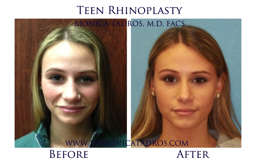 Teen-Rhinoplasty-NJ-before-after-photo-001