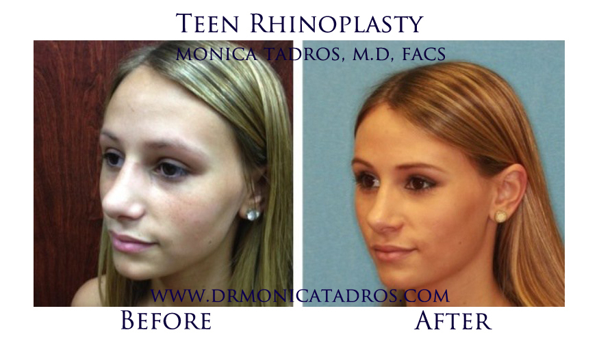 Teen-Rhinoplasty-NJ-before-after-photo-005