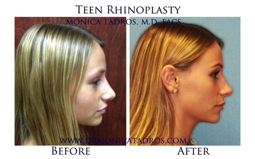 Teen Rhinoplasty Before and After Photo