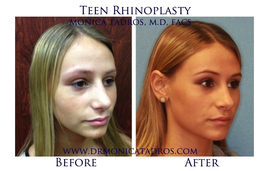Teen-Rhinoplasty-NJ-before-after-photo-007