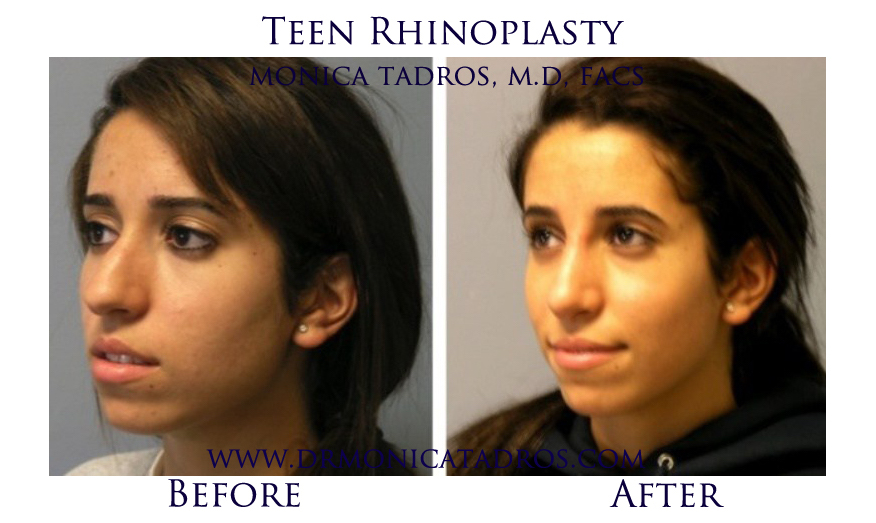 Teen Nose Job in NJ Before and After