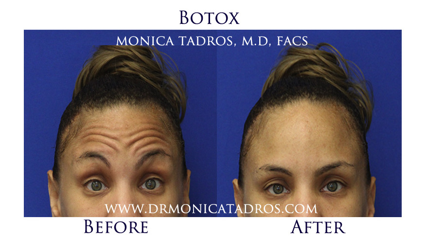botox-before-after-nj-1