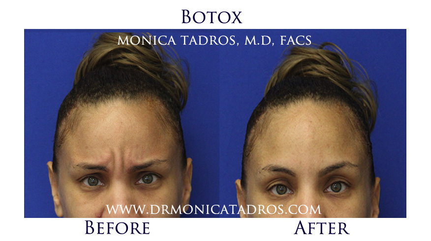 botox-before-after-nj-2