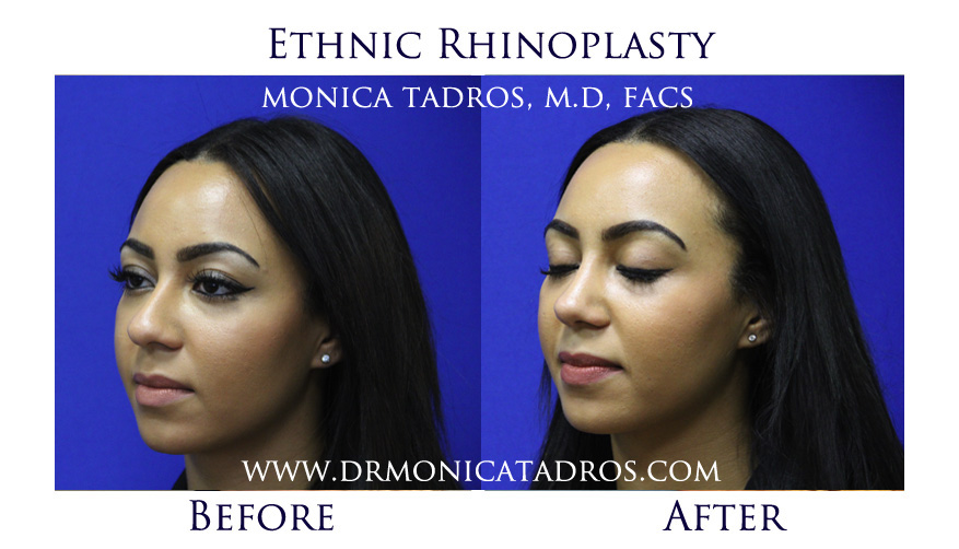 Ethnic Nose Job Before After