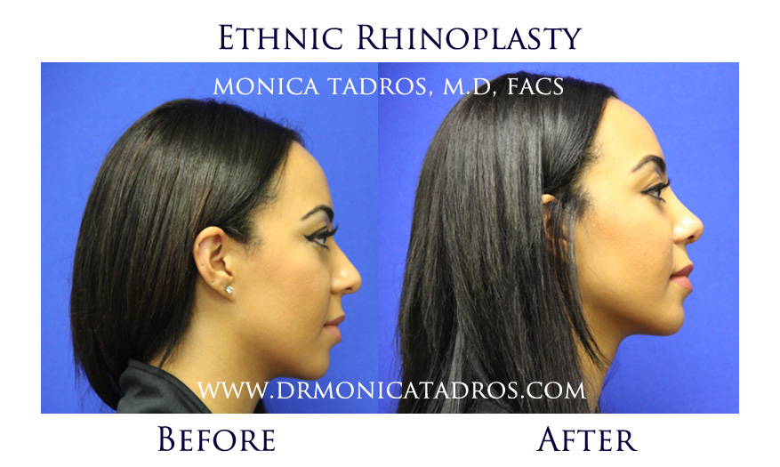 Ethnic Rhinoplasty Before After
