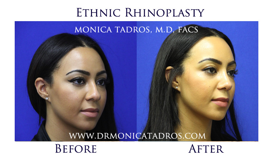 Before and After Picture of Ethnic Nose Job