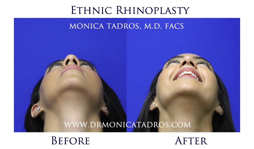 Ethnic Nose Job Before After Photo