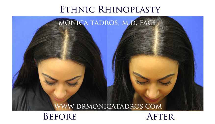 Before & After Ethnic Nose Job