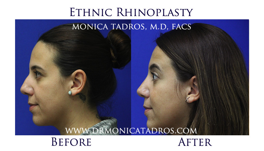 Ethnic Nose Job Before & After Photo