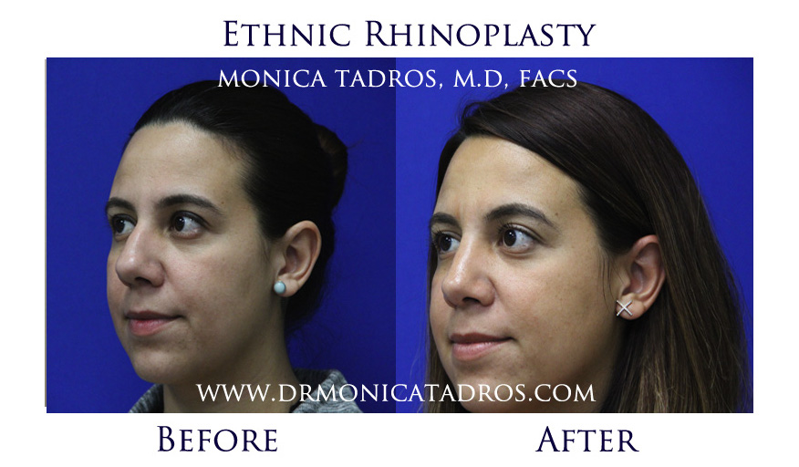 Ethnic Nose Reconstruction Before & After
