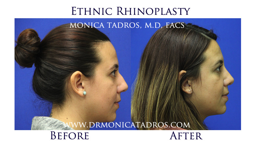 Before and After Ethnic Rhinoplasty in NJ