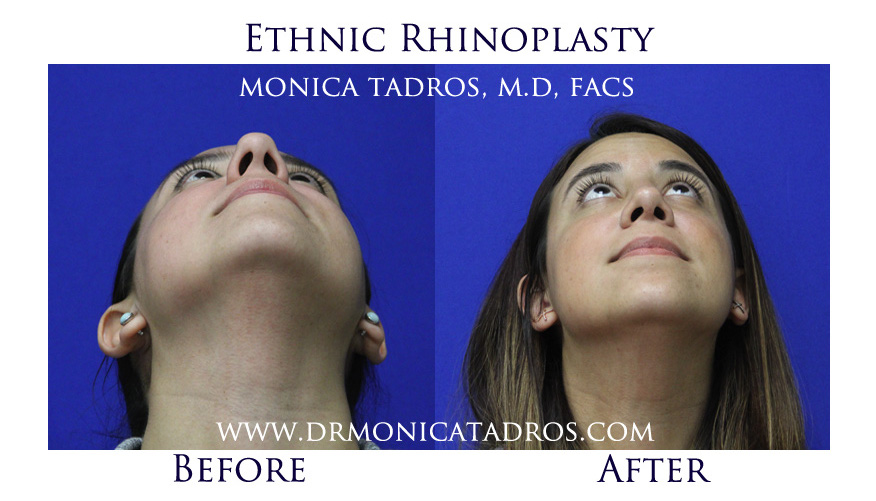 Ethnic Rhinoplasty Before and After Photo