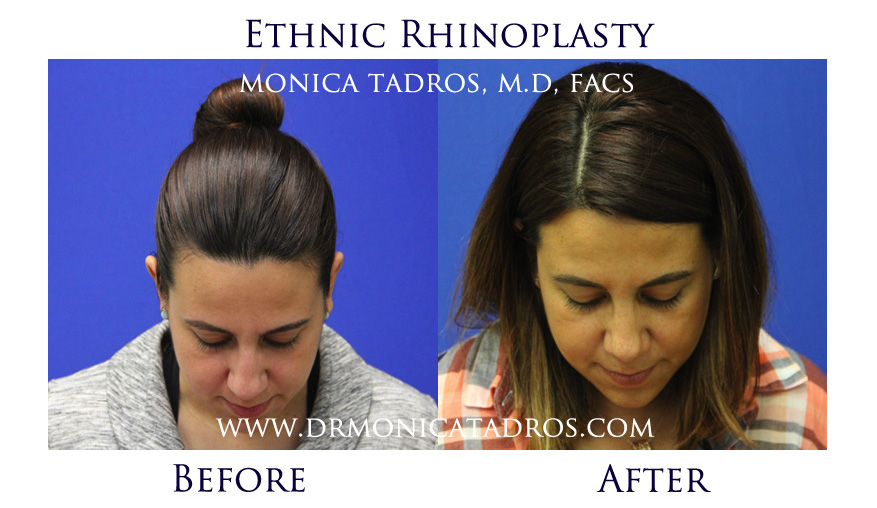 Ethnic Nose Job Before After Picture