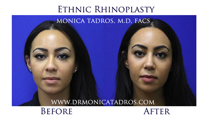 Before and After  High-quality Ethnic Rhinoplasty