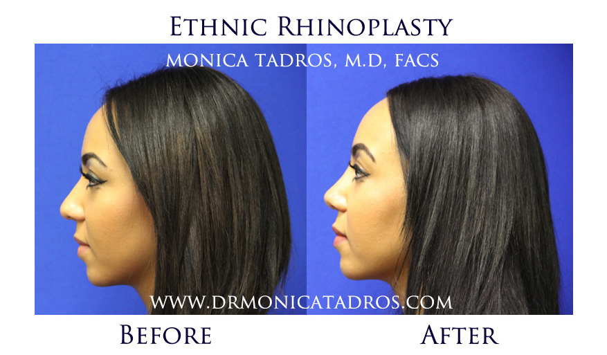 NJ Ethnic Rhinoplasty Before and After Photo