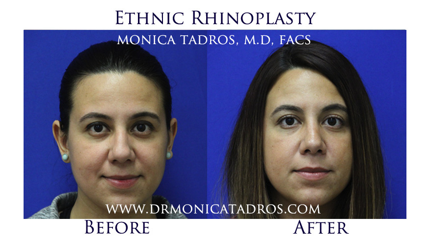 Ethnic Rhinoplasty Nose Job in NJ Before After Photo