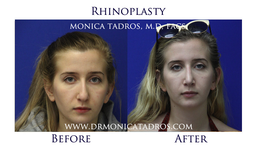 rhinoplasty-before-after-nj-1