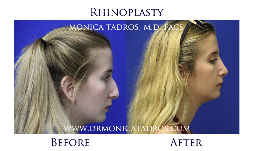 rhinoplasty-before-after-nj-2
