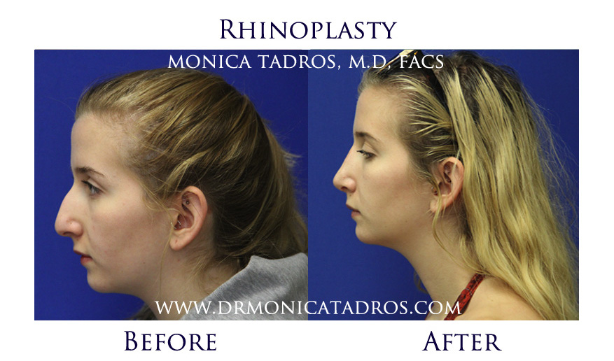 rhinoplasty-before-after-nj-4