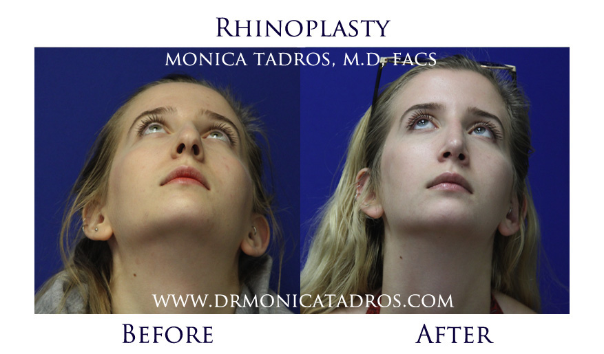 rhinoplasty-before-after-nj-6
