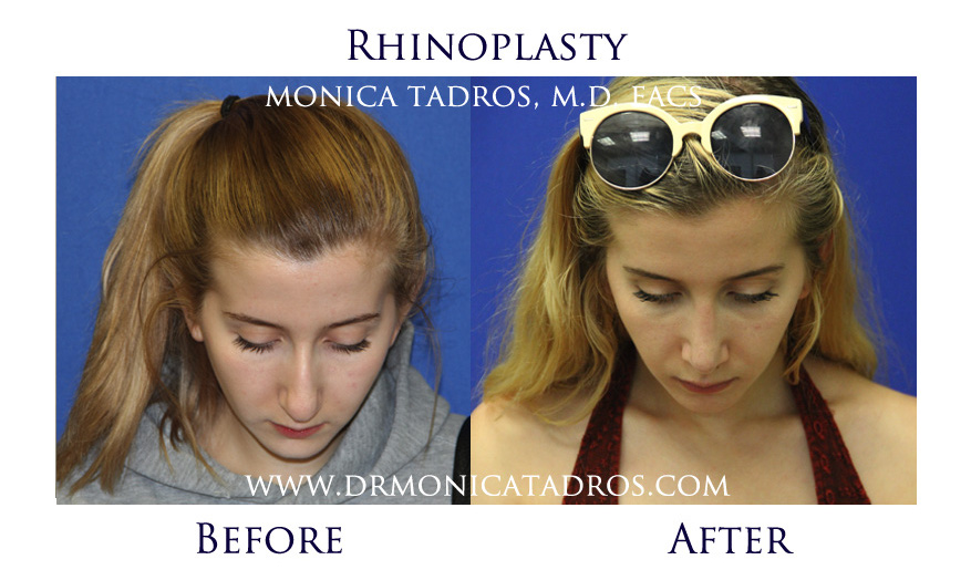 rhinoplasty-before-after-nj-7