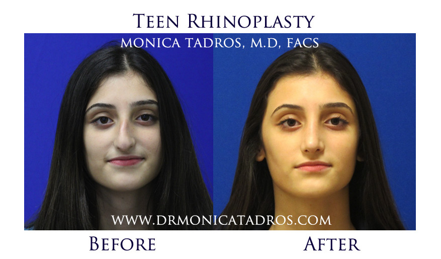 Teen Rhinoplasty in NJ Before and After